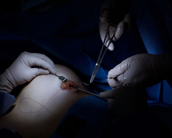 Gynecomastia Surgery